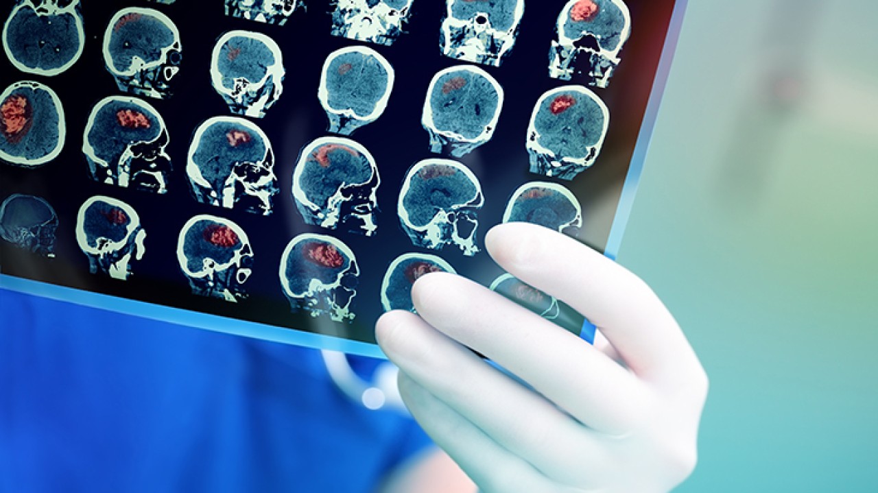 Nöbet geçiren adam,  kendine geldiğinde Fransızca konuşmaya başladı!