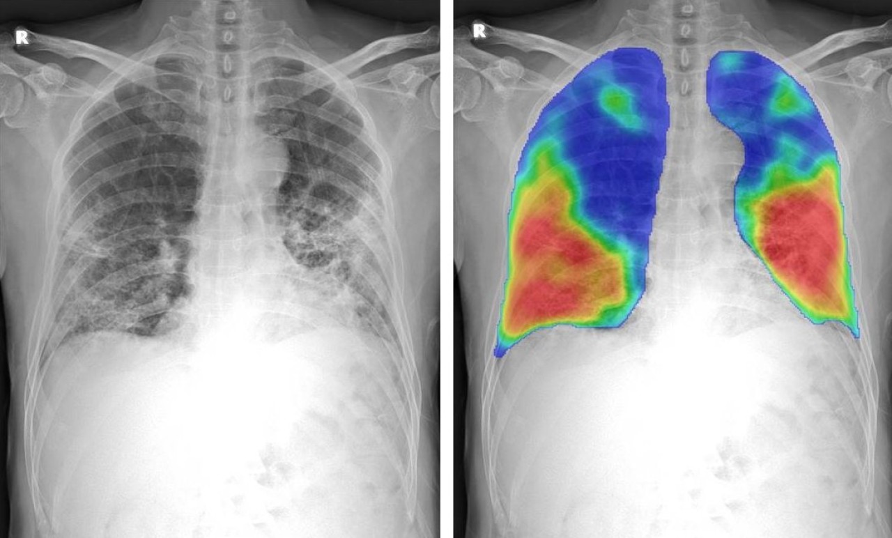 COVID-19'un etkileri röntgenlerde çıkmaya başlayacak!