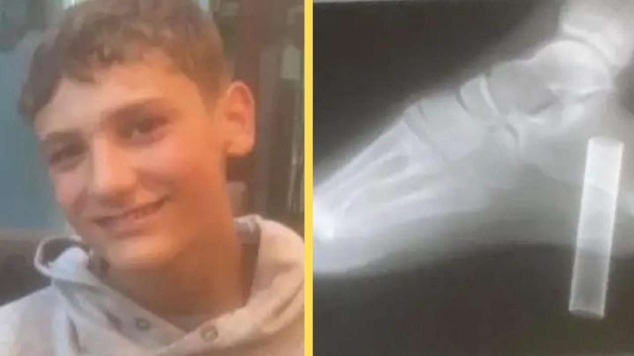 Ayağına elektronik sigara saplanan çocuğun ayağı kesilecekti!