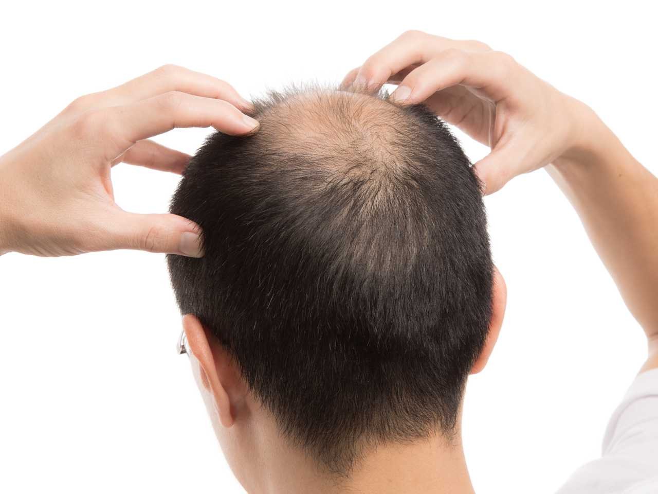 Saç dökülmesinde büyük rol oynuyor! Bilim insanları açıkladı...