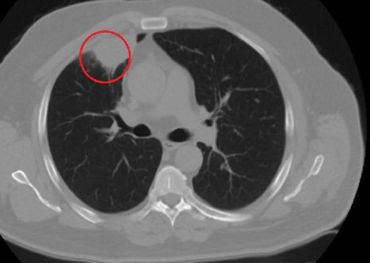 Dünyada bir ilk Türkiye'de yaşandı: COVID-19,  akciğer kanserini taklit etti!