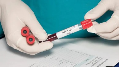 Kök hücre tedavisi HIV'den kurtardı!