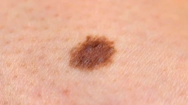 Binlerce insanın cilt kanserini tespit edebilecek akıllı telefon kamera teknolojisi!