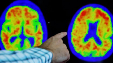 Alzheimer'ı yavaşlatan yeni bir ilaç bulundu!