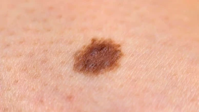 Binlerce insanın cilt kanserini tespit edebilecek akıllı telefon kamera teknolojisi!