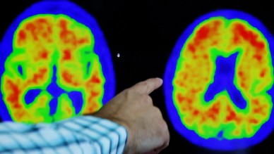 Alzheimer'ı yavaşlatan yeni bir ilaç bulundu!