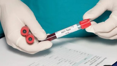 Kök hücre tedavisi HIV'den kurtardı!