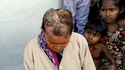 Kafasında büyük 'boynuzlar' çıkan Hintli kadın yardım bekliyor