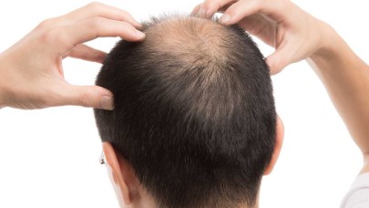 Saç dökülmesinde büyük rol oynuyor! Bilim insanları açıkladı...