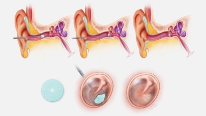 İşitme kaybını tamamen onaran 3D baskılı kulak zarı onarım yaması üretildi