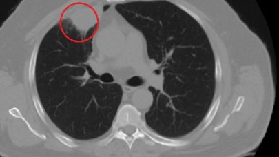 Dünyada bir ilk Türkiye'de yaşandı: COVID-19,  akciğer kanserini taklit etti!