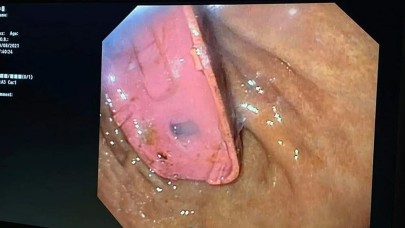 3310'la şaka olmaz! Bir adamın midesinden Nokia 3310 çıkarıldı...