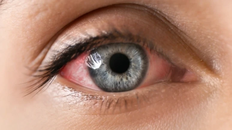 Göz enfeksiyonundan korunmanın 6 yolu