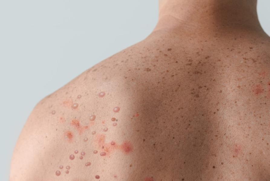 abd de acil durum ilan edildi maymun çiceği (3)