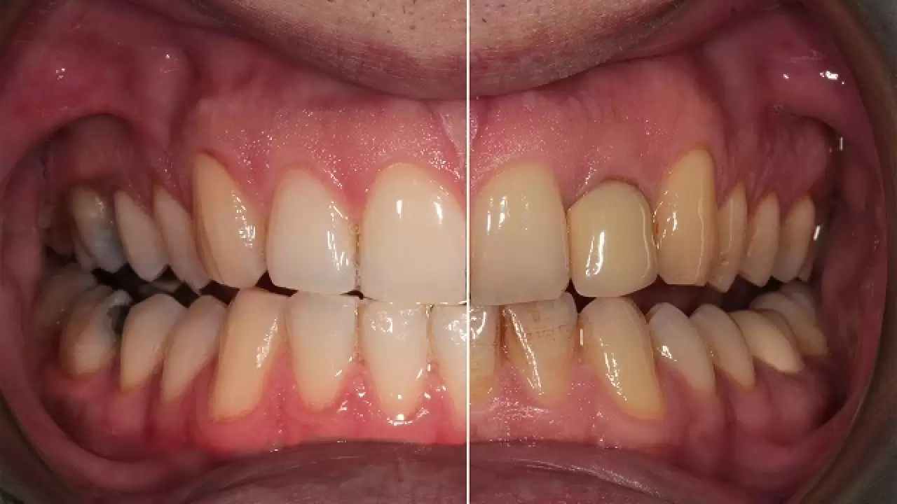 mikrobotlar diş (1)